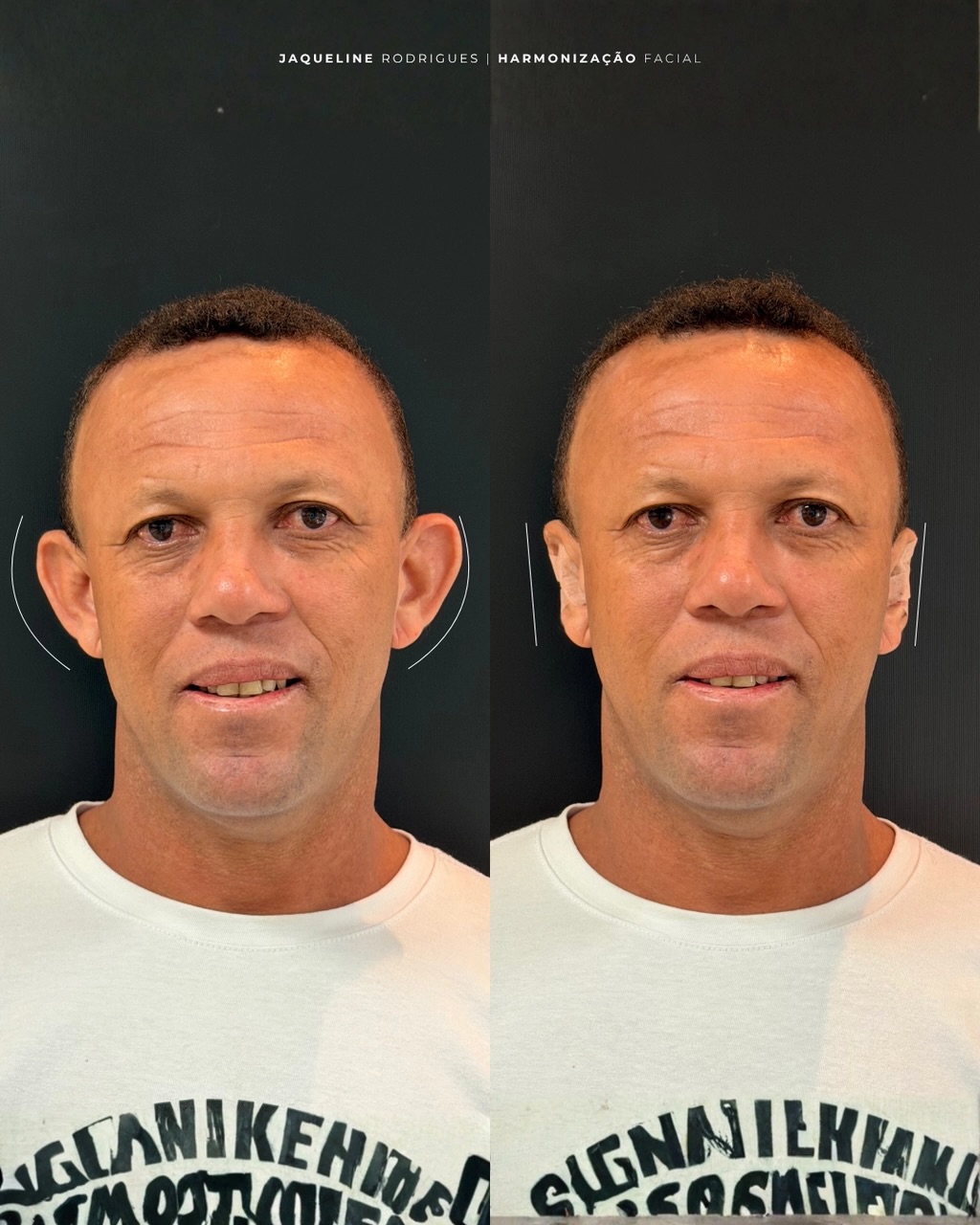 Otomodelação - antes