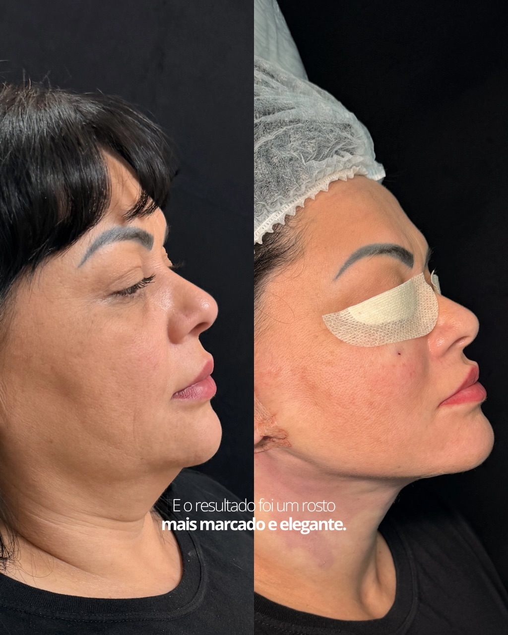 Lipoaspiração de Papada de Alta Definição - antes