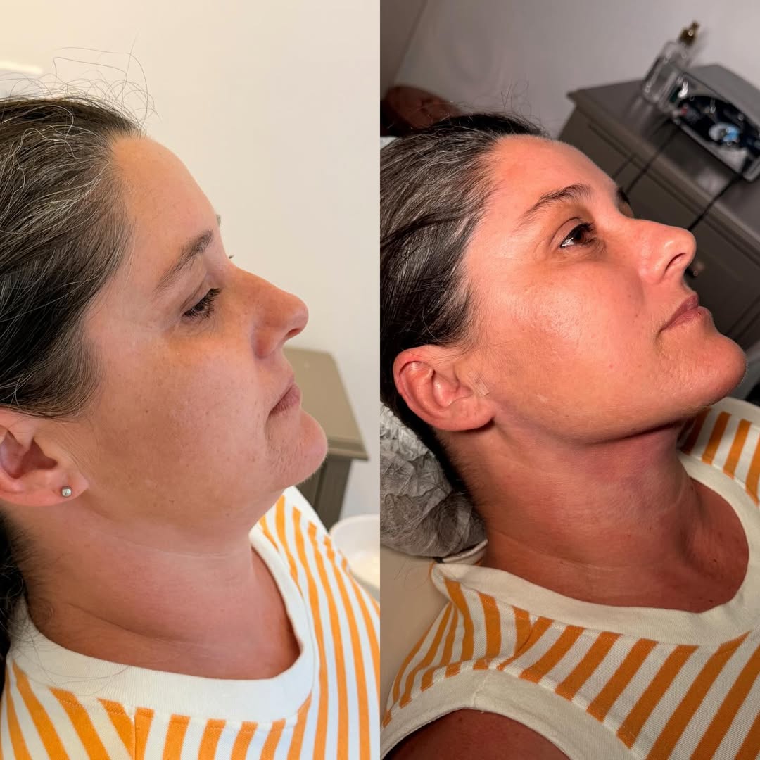 Lipoaspiração de Papada de Alta Definição - depois